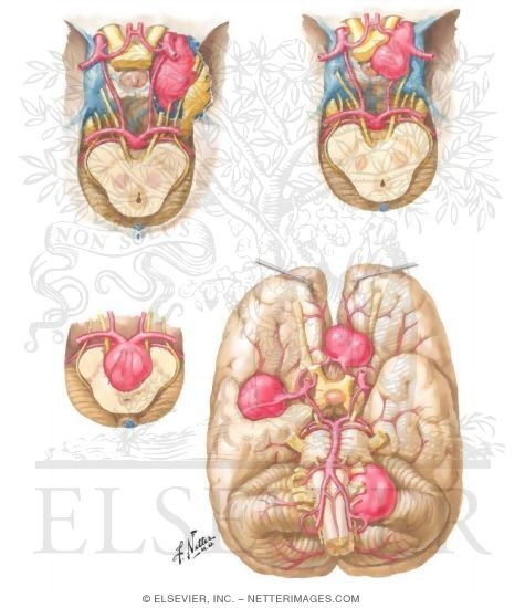 Giant Congenital Aneurysms