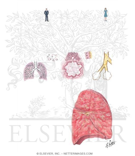 Watermarked preview of unlabeled image: Cystic Fibrosis (CF, Mucoviscidosis)