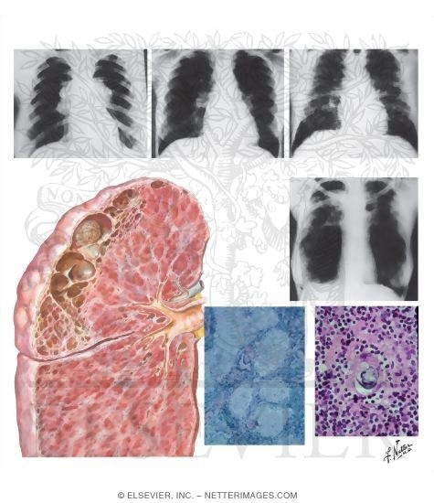 Watermarked preview of unlabeled image: Sarcoidosis