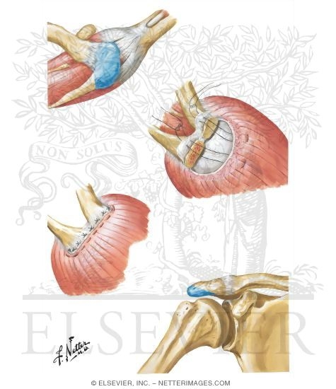 Open Acromioplasty (Partial Acromionectomy)