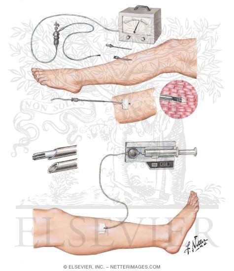 Measurement of Intracompartmental Pressure