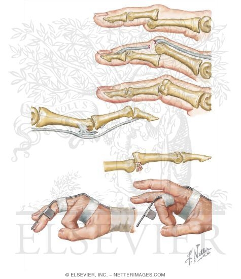 Dorsal and Palmar Interphalangeal Joint Dislocations