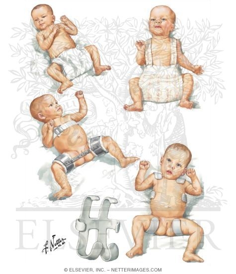 Watermarked preview of unlabeled image: Positioning Devices Used in CDH