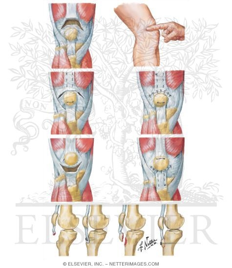 Watermarked preview of unlabeled image: Disruption of Quadriceps Femoris Tendon or Patellar Ligament