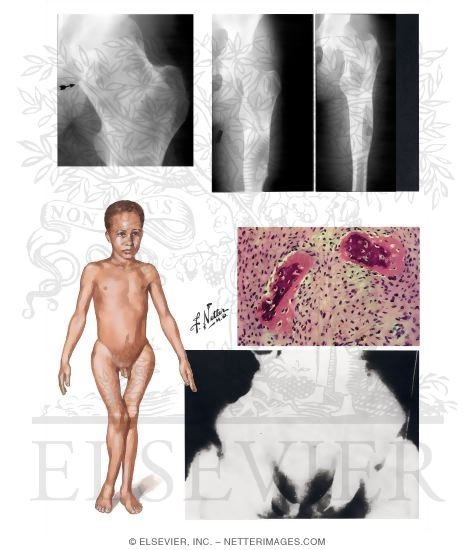 Watermarked preview of unlabeled image: Fibrous Dysplasia