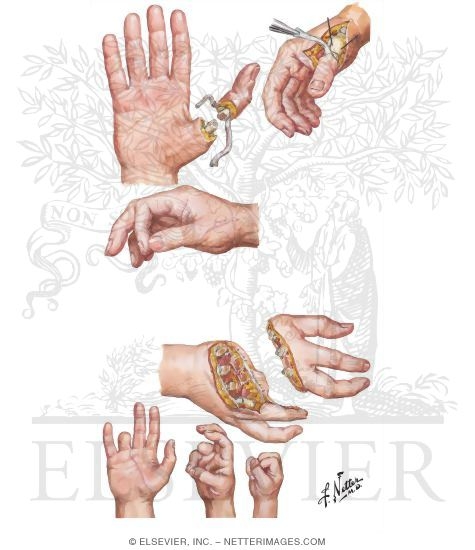 Watermarked preview of unlabeled image: Replantation of Avulsed Thumb and Midpalm