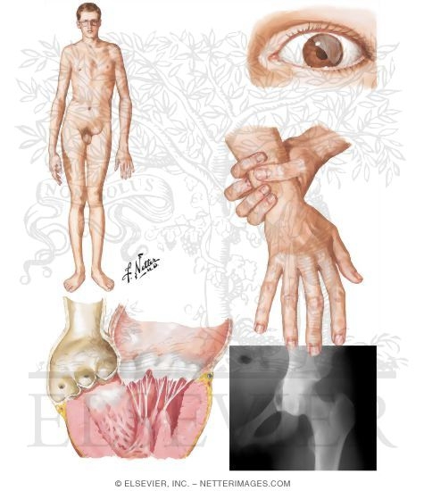 Marfan's Syndrome