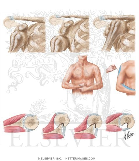 Anterior Dislocation of Glenohumeral Joint