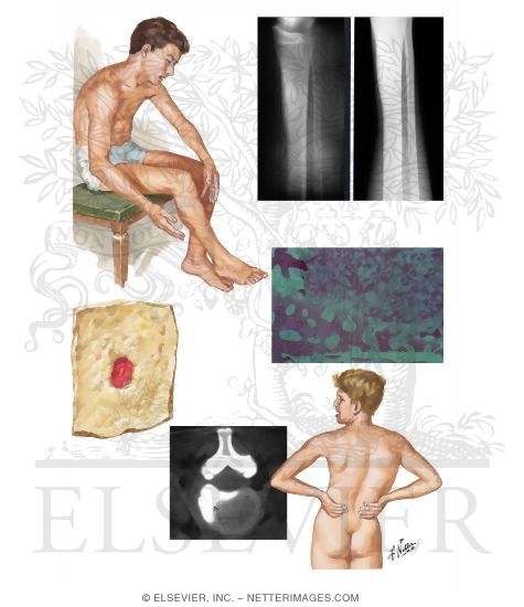 Watermarked preview of unlabeled image: Osteoid Osteoma