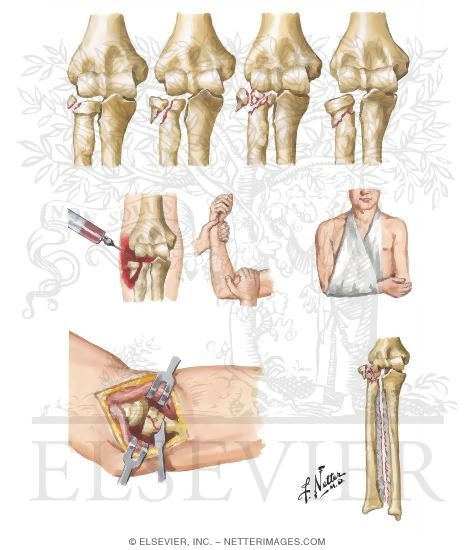 Watermarked preview of unlabeled image: Fracture of Head and Neck of Radius