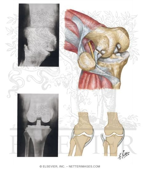 Lateral Release for Valgus Deformity of Knee