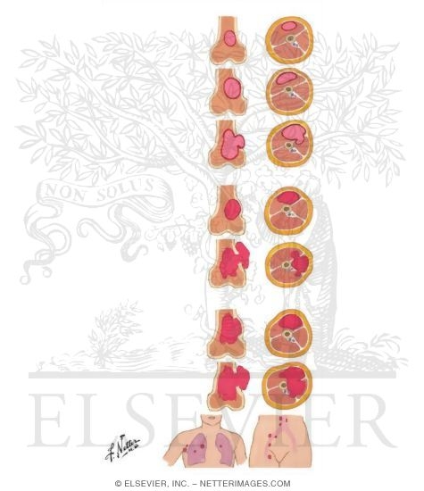 Watermarked preview of unlabeled image: Staging of Musculoskeletal Tumors