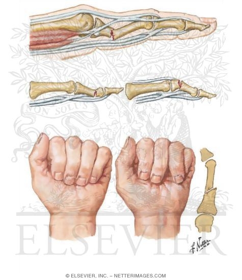 Fracture of Proximal and Middle Phalanges