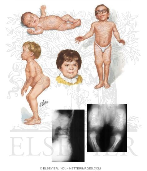 Kniest Dysplasia