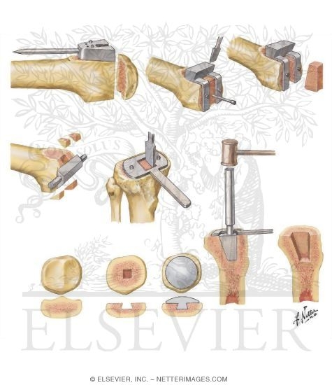 Watermarked preview of unlabeled image: Technique for Total Knee Replacement