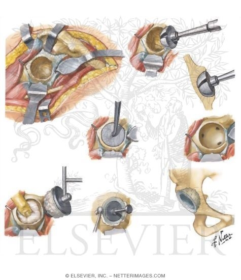 Watermarked preview of unlabeled image: Technique for Total Hip Replacement