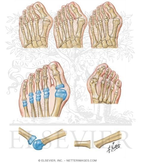 Watermarked preview of unlabeled image: Surgical Reconstruction of Severe Rheumatoid Forefoot Deformity