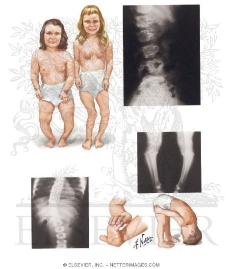 Pseudoachondroplasia