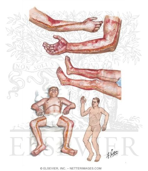 Escharotomy for Burns
