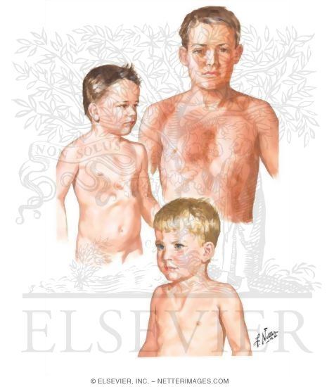 Watermarked preview of unlabeled image: Congenital Deformities of Thoracic Cage