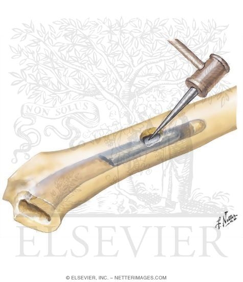 Watermarked preview of unlabeled image: Fractures of Femur and Femoral Component