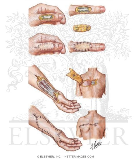 Watermarked preview of unlabeled image: Venous Flap for Defect After Replantation of Thumb, Free Vascularized Scapular Flap After Replantation of Forearm
