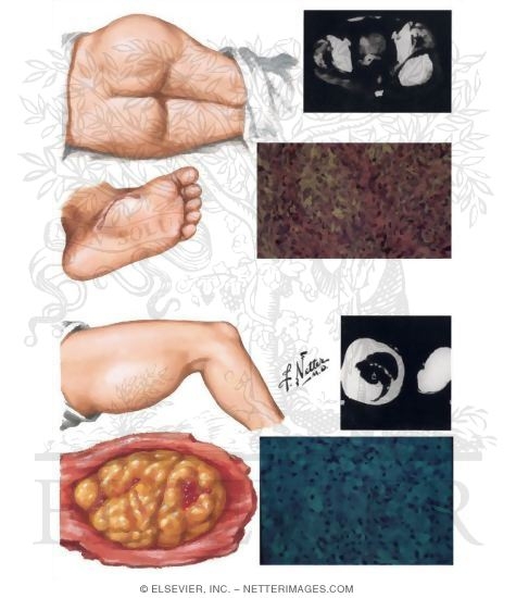 Synovial Sarcoma, Liposarcoma