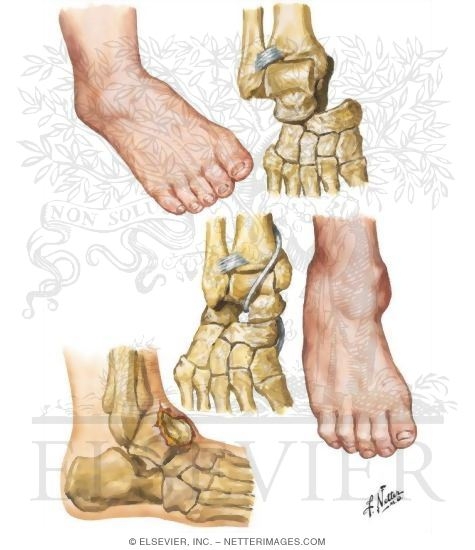Dislocation of Subtalar Joint and Talus