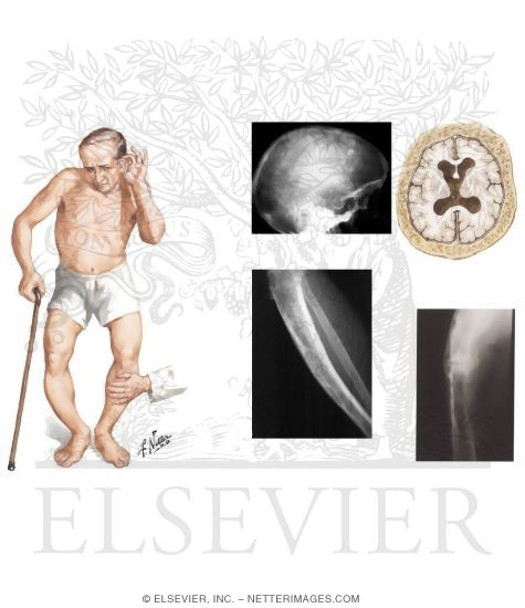 Paget's Disease of the Bone