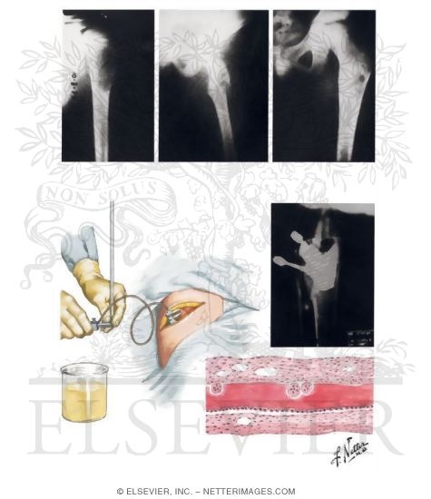 Simple Bone Cyst