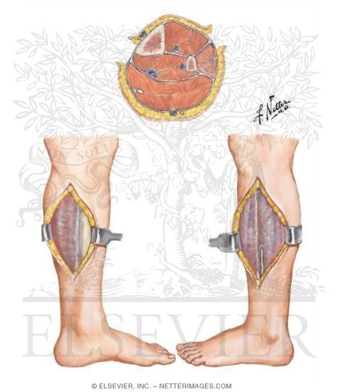Watermarked preview of unlabeled image: Incisions for Compartment Syndrome of Leg