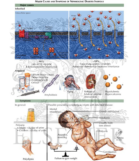 Major Causes and Symptoms of Nephrogenic Diabetes Insipidus (Continued)