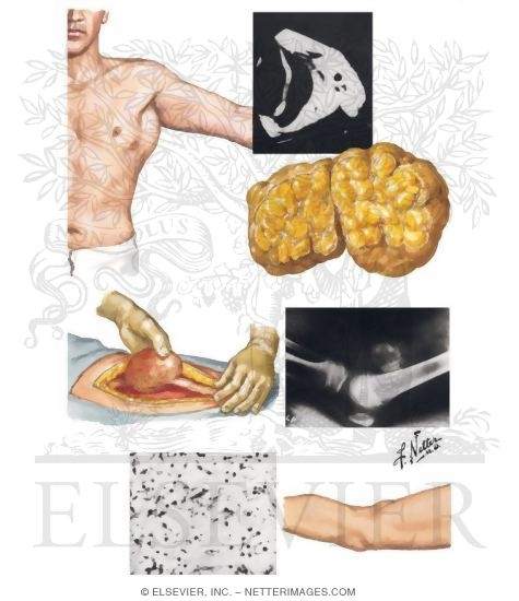 Lipoma, Neurofibroma, Myositis Ossificans