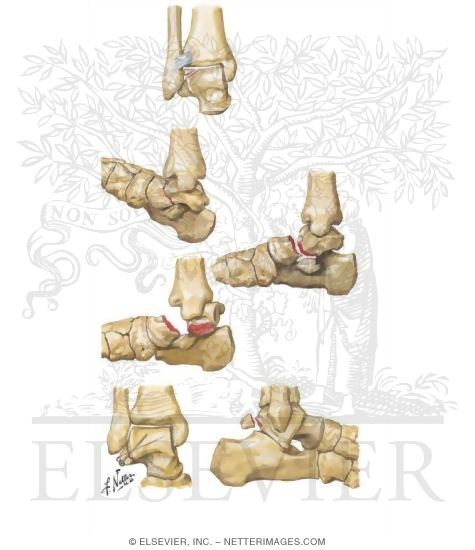 Fracture of Talus
Fracture of Talar Neck