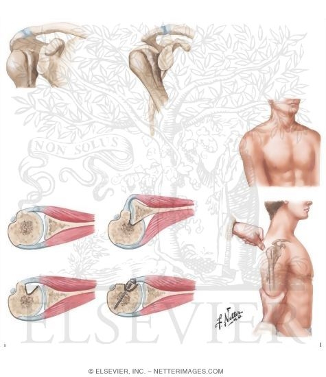 Watermarked preview of unlabeled image: Posterior Dislocation of Glenohumeral Joint