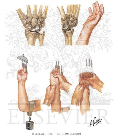 Dislocation of Carpus