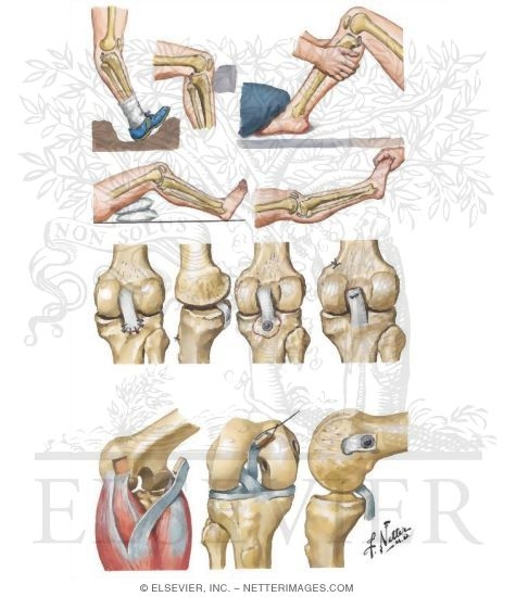 Watermarked preview of unlabeled image: Rupture of Posterior Cruciate Ligament