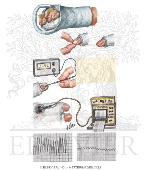 Postoperative Dressing and Monitoring of Blood Flow