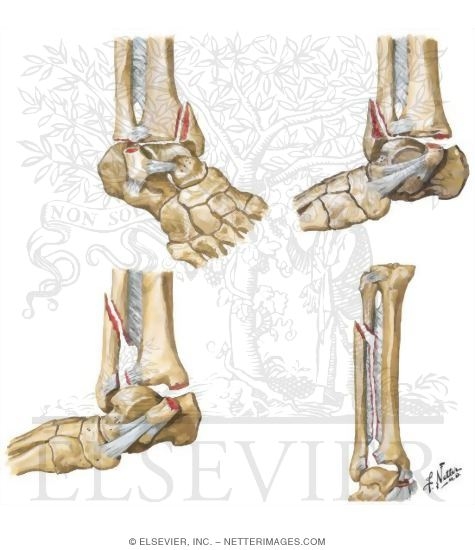 Rotational Fracture of Ankle Mortise