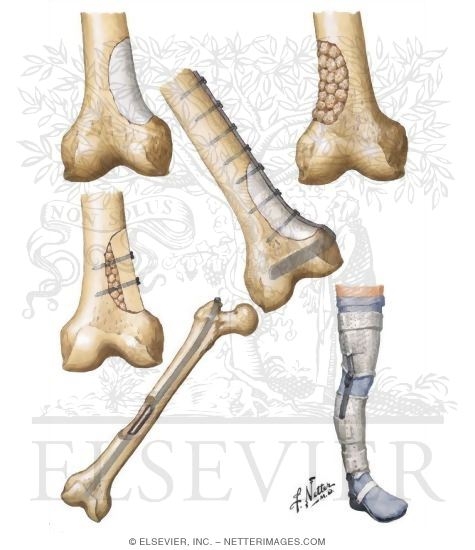 Watermarked preview of unlabeled image: Reconstruction or Stabilization After Partial Excision or Curettage (Fracture Prophylaxis)
Fracture Prophylaxis