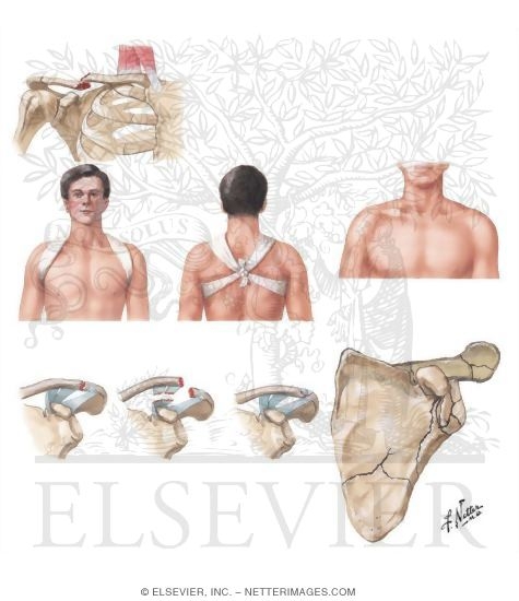 Fracture of Clavicle and Scapula