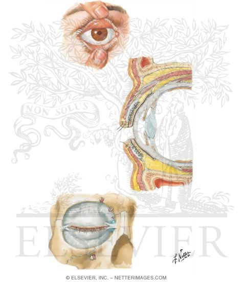Eyelids
