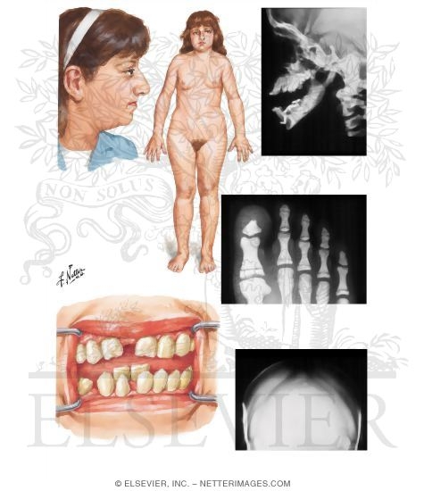 Pycnodysostosis