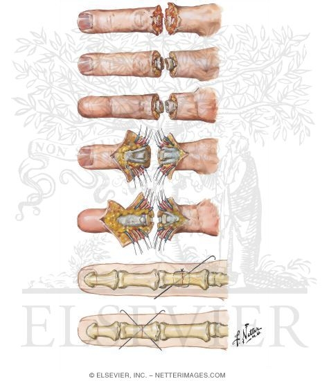 Debridement, Incisions, and Repair of Bone in Replantation of Digit
