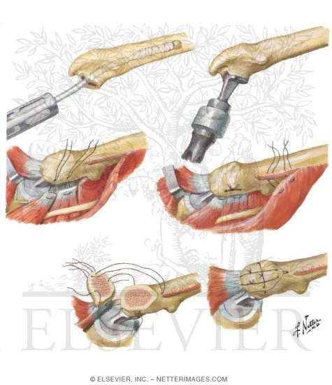 Watermarked preview of unlabeled image: Technique for Total Hip Replacement