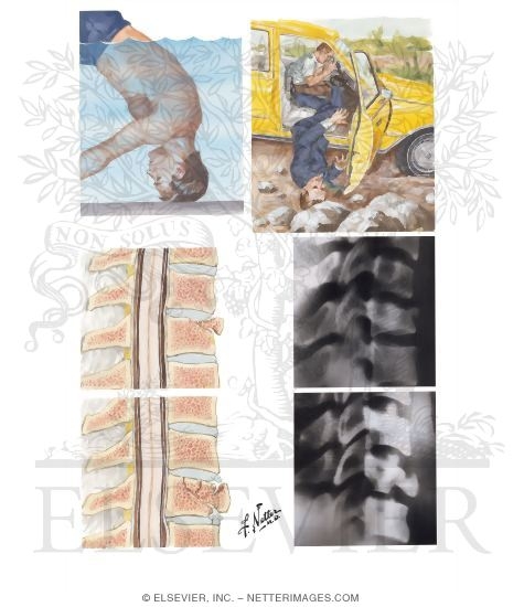Watermarked preview of unlabeled image: Compression Fractures of Cervical Spine