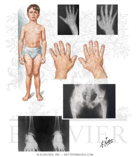 Multiple Epiphyseal Dysplasia