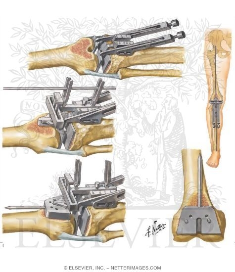 Watermarked preview of unlabeled image: Technique for Total Knee Replacement