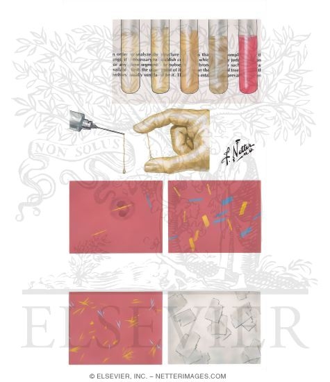 Watermarked preview of unlabeled image: Synovial Fluid Examination