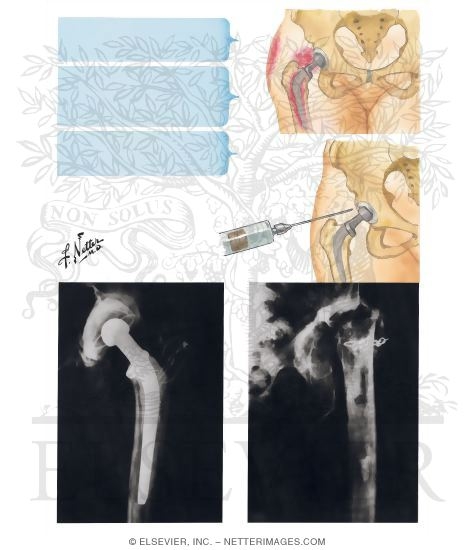 Watermarked preview of unlabeled image: Total Hip Replacement: Infection